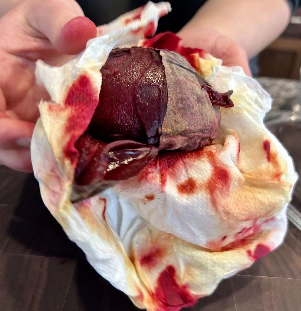 Using paper towels to remove the peel from the microwaved beet roots.